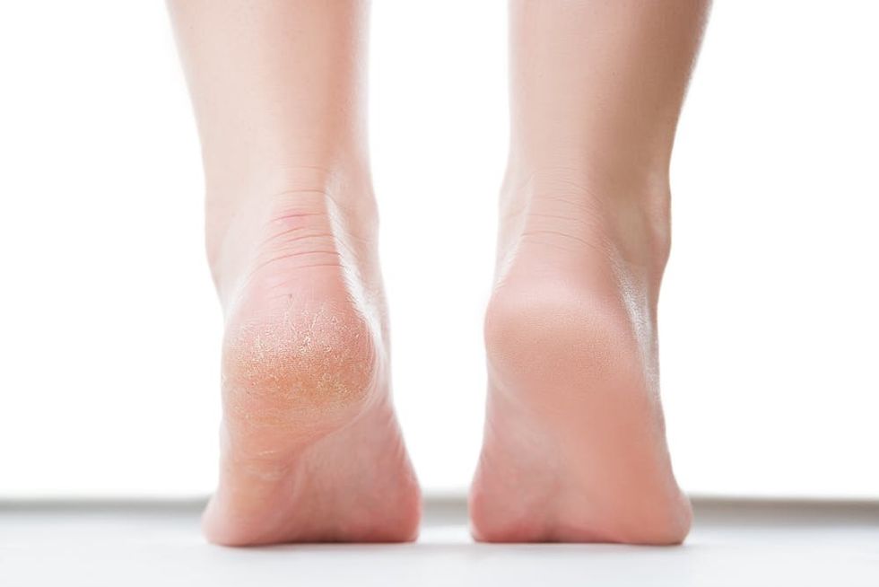 why-do-my-feet-keep-peeling-brit-co