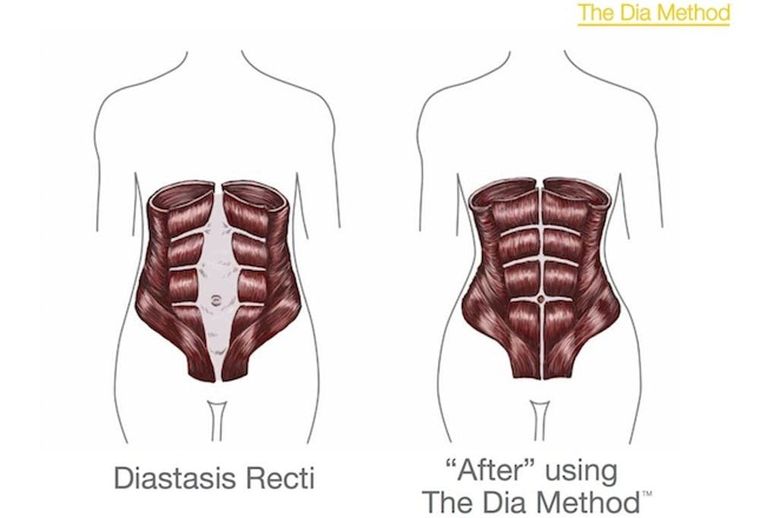 Ultimate Guide to Diastasis Recti (aka Mama Pooch!) – Mommy Plus More